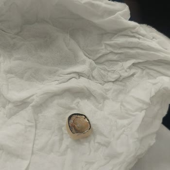 Kaplama Hatası Ve Doktorun Çözüm Teklifi Nedeniyle İade Talebi