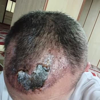 Murat Makasçı Klinik Saç Ekim Kliniğinde Çözümsüz Hasar Ve Güvensizlik