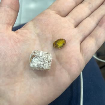 Lokumda Kabuklu Fıstık Nedeniyle Diş Kırılması Ve Gıda Güvenliği İhlali