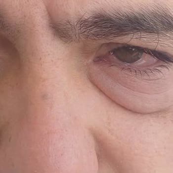 Otel Havuzundaki Kimyasallar Gözlerimde İltihap Oluşturdu Ve Yardım Gelmedi