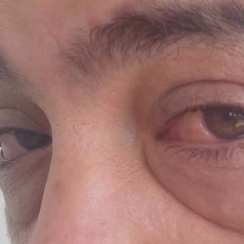 Otel Havuzundaki Kimyasallar Gözlerimde İltihap Oluşturdu Ve Yardım Gelmedi