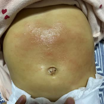 Kızımda Nutrigen Üzüm Çekirdeği Şurubu Nedeniyle Şiddetli Alerjik Reaksiyon Ve 500 TL İade Talebi