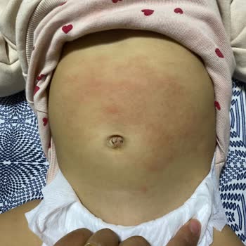 Kızımda Nutrigen Üzüm Çekirdeği Şurubu Nedeniyle Şiddetli Alerjik Reaksiyon Ve 500 TL İade Talebi