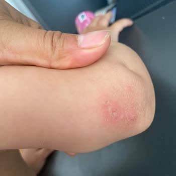 Kızımda Nutrigen Üzüm Çekirdeği Şurubu Nedeniyle Şiddetli Alerjik Reaksiyon Ve 500 TL İade Talebi