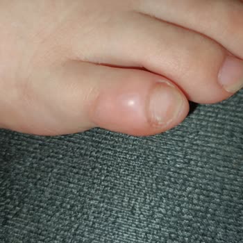 Ayak Şişmesi Ve Su Toplanması Nedeniyle Adidas Ayakkabının Değişimi Reddedildi