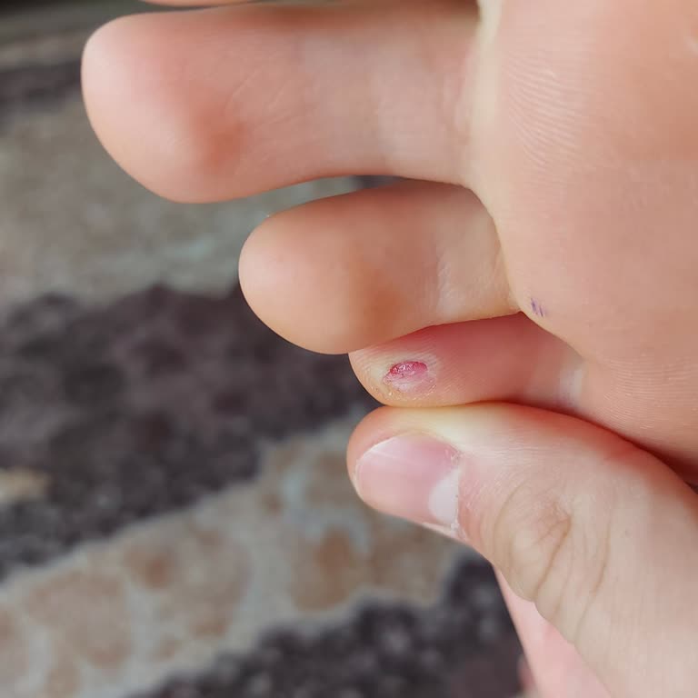 Trendyol Ve Koray Spor'dan Gelen Ayakkabı Yarası Ve Gerekçesiz İade Reddi
