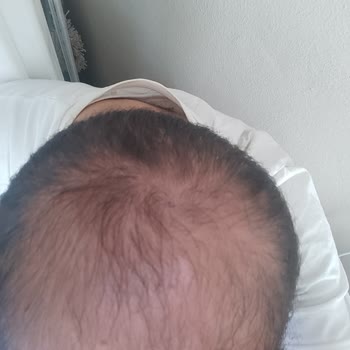 Saç Vitamini Tedavisinde Ürün Değişikliği Ve Gelişme Olmayan Seanslar