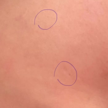 İğneli Epilasyon Sonrası Yüzde Doku Kaybı Ve Zorla Alınan İğne Ücretinin İade Reddi