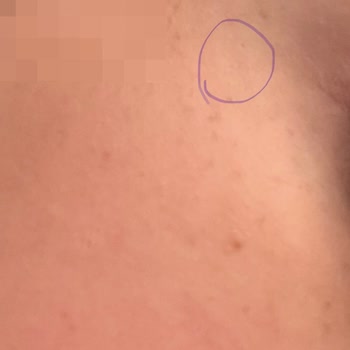 İğneli Epilasyon Sonrası Yüzde Doku Kaybı Ve Zorla Alınan İğne Ücretinin İade Reddi