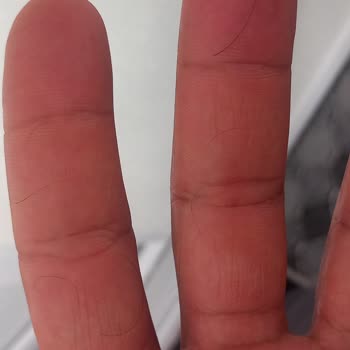 Uraw Saç Spreyinden Şiddetli Saç Dökülmesi Ve Ücret İadesi Talebi