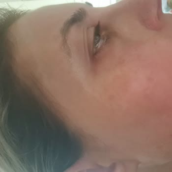 Saç Boyasını Aktaran Ve Alerjik Reaksiyona Neden Olan Şampuan