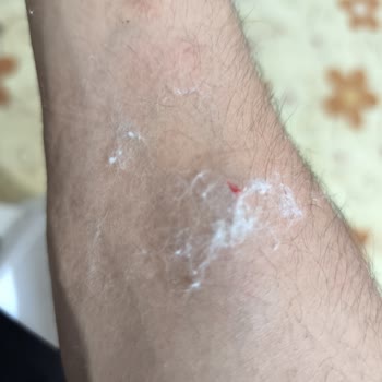Acil Serviste Saygısız Davranış, Yanlış Damarlama Ve Uzun Bekleme Şikayeti