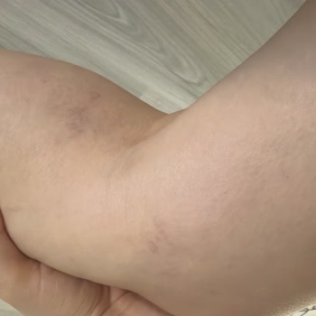 Mavi Damar Estetiği Sonrası Kalıcı Morluk Ve Kılcal Damar Hasarı, 35.000 TL İade Talebi