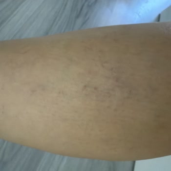 Mavi Damar Estetiği Sonrası Kalıcı Morluk Ve Kılcal Damar Hasarı, 35.000 TL İade Talebi
