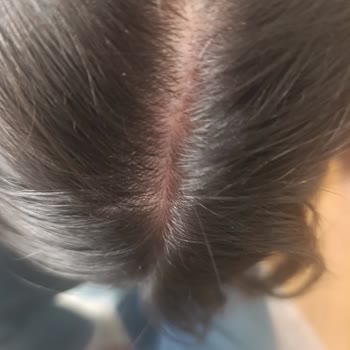 Duru Nem Bombası Şampuanı Kafa Derisinde Şiddetli Kızarıklık Ve Kepek