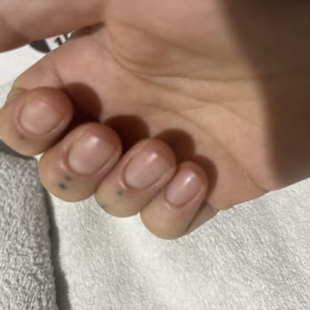 Esra Ünlütürk Beauty & Aesthetics Tırnak Ve Çevresinde Şişlik, Kızarıklık Ve Kanama Oluştu