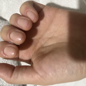 Esra Ünlütürk Beauty & Aesthetics Tırnak Ve Çevresinde Şişlik, Kızarıklık Ve Kanama Oluştu