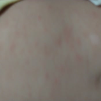 Bebeğimin Cildinde Alerjik Reaksiyon: Bioderma Atoderm Ürünleri İade Talebi