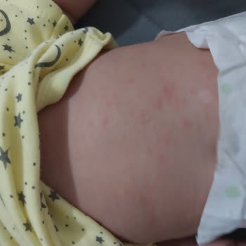 Bebeğimin Cildinde Alerjik Reaksiyon: Bioderma Atoderm Ürünleri İade Talebi