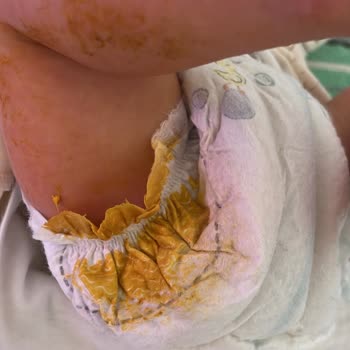 Prima Premium Care Bebek Bezinde Tekrarlayan Sızdırma Sorunu