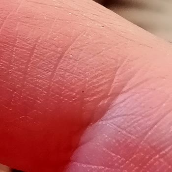 Cilt Sorunuma Sadece Psikiyatrik Yönlendirme, Kök Neden Araştırılmadı