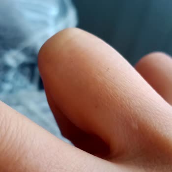 Cilt Sorunuma Sadece Psikiyatrik Yönlendirme, Kök Neden Araştırılmadı