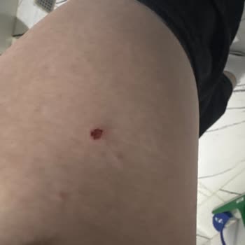Epify Tüy Dökücü Kremde Cilt Batıkları Ve Sürekli Rahatsızlık