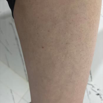 Epify Tüy Dökücü Kremde Cilt Batıkları Ve Sürekli Rahatsızlık