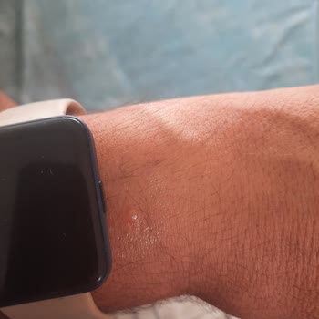 Xiaomi Watch 2 Pro Saatinin Aşırı Isınması Bileği Yaktı