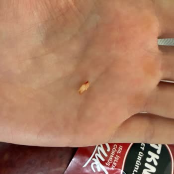 Sucuktan Çıkan Sert Kemik Parçası Dişimi Kırdı, Güven Ve Kalite Kontrol Talebi