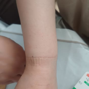 Magnum Dondurmasında Küflü Ürün Ve Ciddi Alerjik Reaksiyon