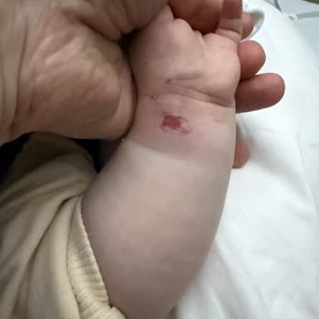 Bebek Damar Yolu Değişiminde Ciddi İhmal Ve Bilek Hasarı
