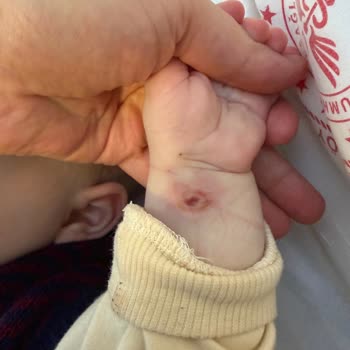 Bebek Damar Yolu Değişiminde Ciddi İhmal Ve Bilek Hasarı