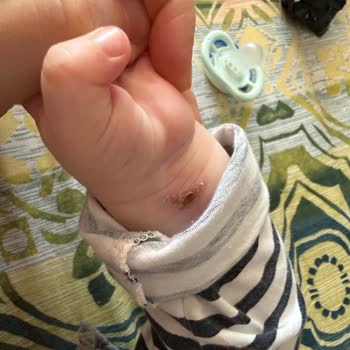 Bebek Damar Yolu Değişiminde Ciddi İhmal Ve Bilek Hasarı