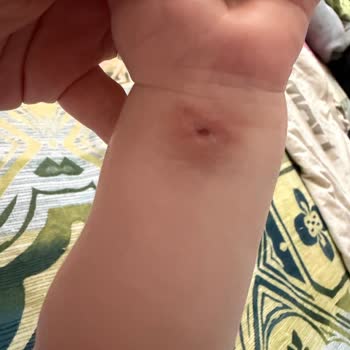 Bebek Damar Yolu Değişiminde Ciddi İhmal Ve Bilek Hasarı