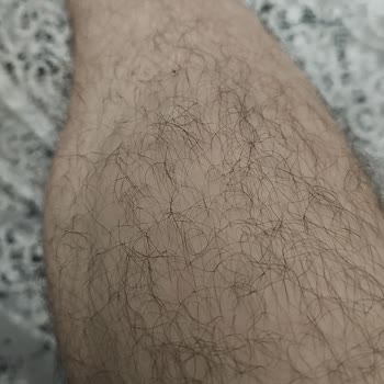 Mecidiyeköy Enza Şubesinde Epilasyon Paketi Sonuçsuz Ücret İadesi Talebi
