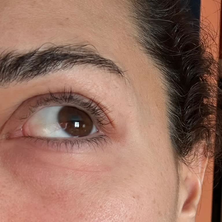 Caudalie Göz Kreminde Şiddetli Yanma Ve Kızarıklık, Doktor Raporu Talebi Ve İade İsteği
