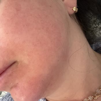 Garnier Hyaluron Barber Repair Maskesi Kullanımı Sonrası Şiddetli Alerjik Reaksiyon Ve İade Talebi