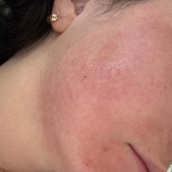 Garnier Hyaluron Barber Repair Maskesi Kullanımı Sonrası Şiddetli Alerjik Reaksiyon Ve İade Talebi