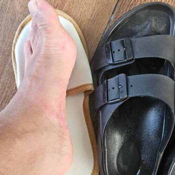 Birkenstock Ayak Tahrişi Ve Markanın Çözüm Sunmaması