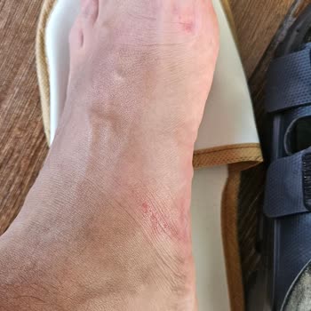Birkenstock Ayak Tahrişi Ve Markanın Çözüm Sunmaması
