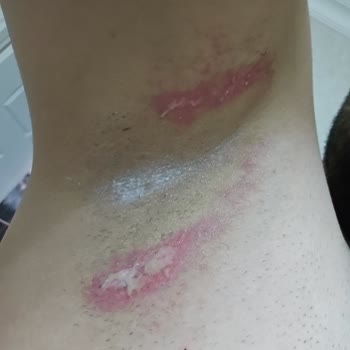 Epify Tüy Dökücü Kremi Koltuk Altında Şiddetli Yanık Ve Tahriş