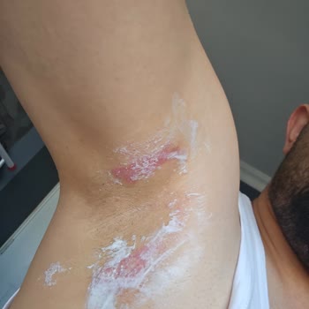 Epify Tüy Dökücü Kremi Koltuk Altında Şiddetli Yanık Ve Tahriş