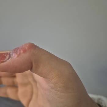 B-Good Tekstil Yara Bandı Nedeniyle Şiddetli Alerjik Reaksiyon