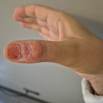 B-Good Tekstil Yara Bandı Nedeniyle Şiddetli Alerjik Reaksiyon