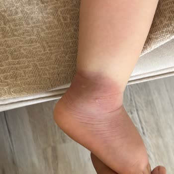 Yetersiz Sivrisinek İlaçlaması Çocuğumun Sağlığını Tehlikeye Atıyor
