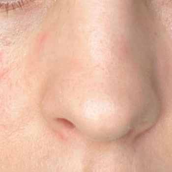 Bioderma Göz Kremi Yüzümde Yanma Ve Mahvolma Yarattı