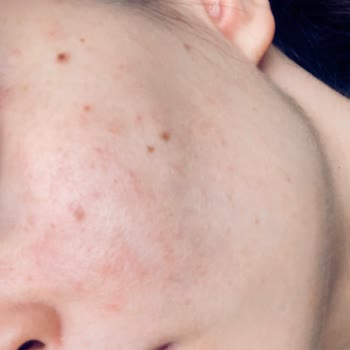 Bioderma Göz Kremi Yüzümde Yanma Ve Mahvolma Yarattı