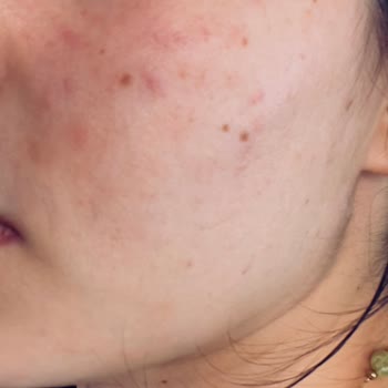 Bioderma Göz Kremi Yüzümde Yanma Ve Mahvolma Yarattı