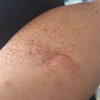 Hassas Ciltte Kullanılan Kıl Dökücü Sprey Yanık Ve Yaralar Oluşturdu